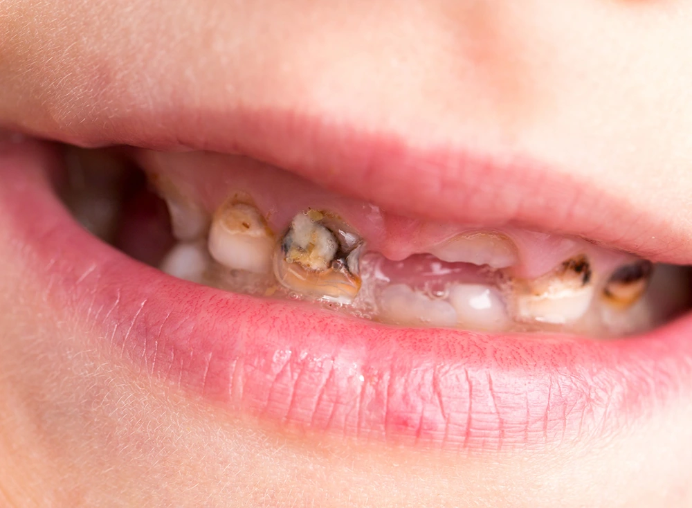 پیشگیری از پوسیدگی دندان در کودکان
